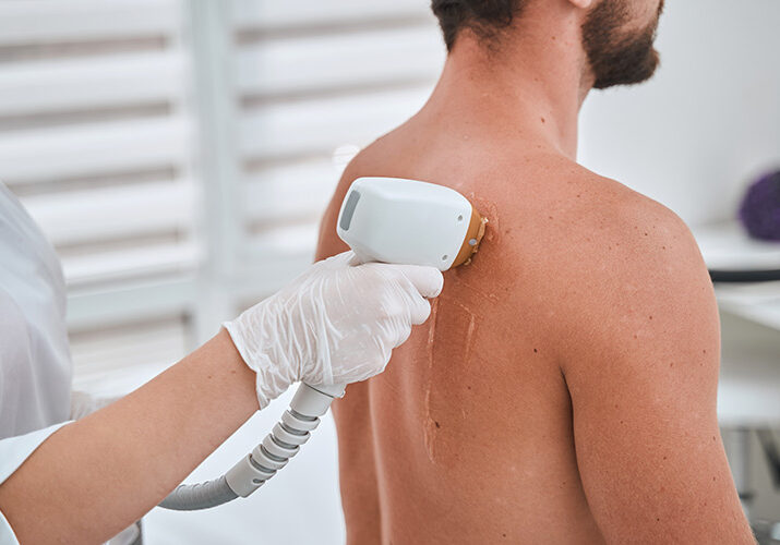 Understanding the Science of Laser Therapy for Hyperpigmentation: Everything You Should Know